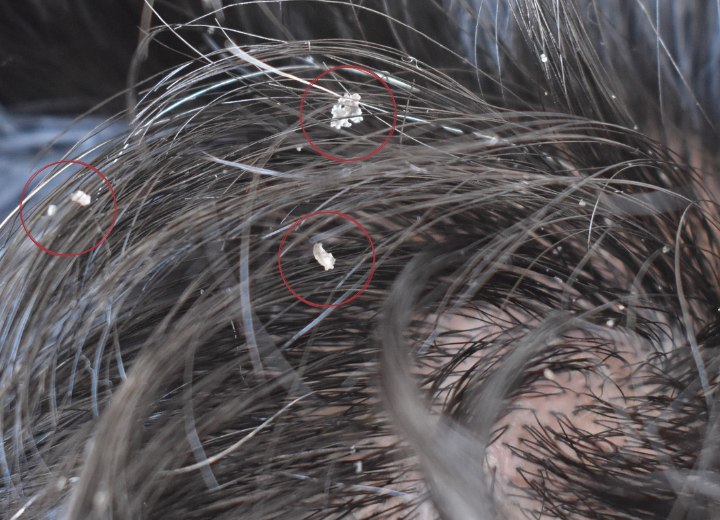 Cabello con escamas de caspa